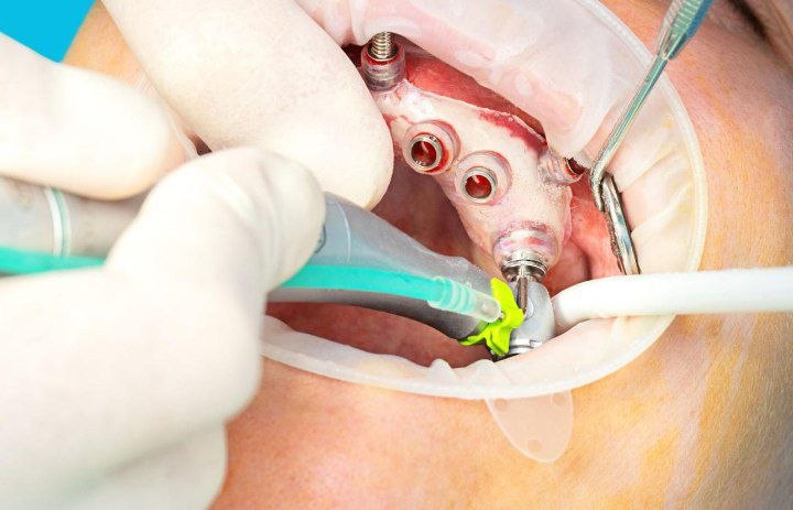 Endostyle implant