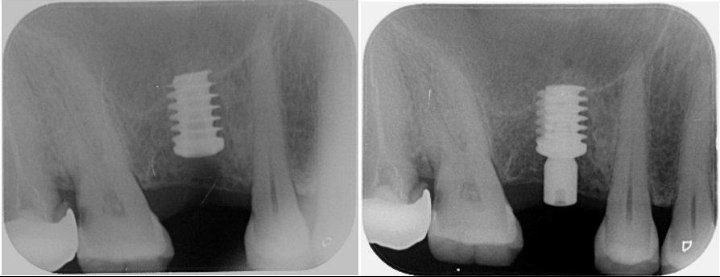 choosing-the-diameter-and-length-of-the-implant