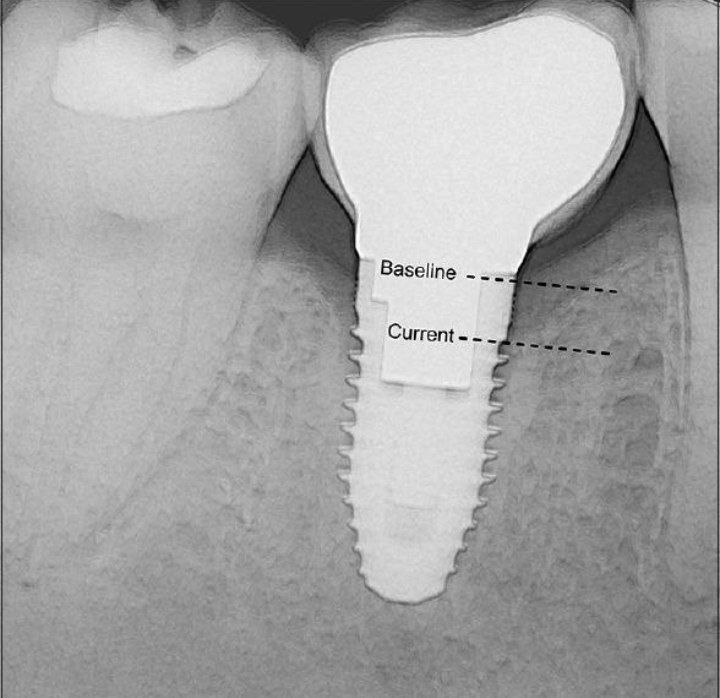 choosing-the-diameter-and-length-of-the-implant