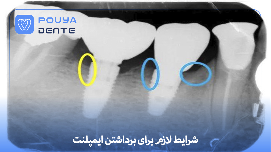 Implant removal