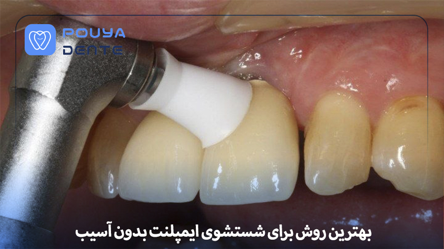 Implant cleaning