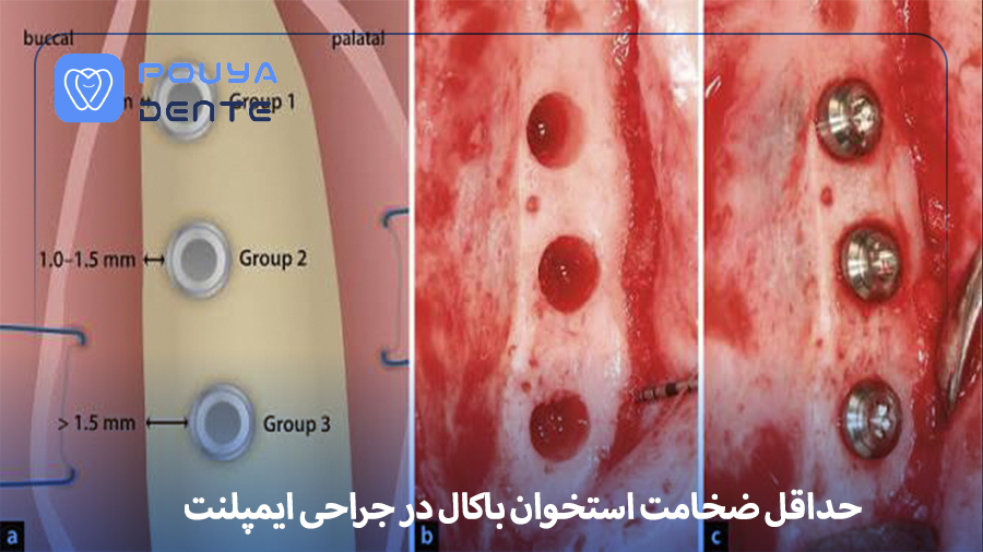 Minimum buccal bone thickness