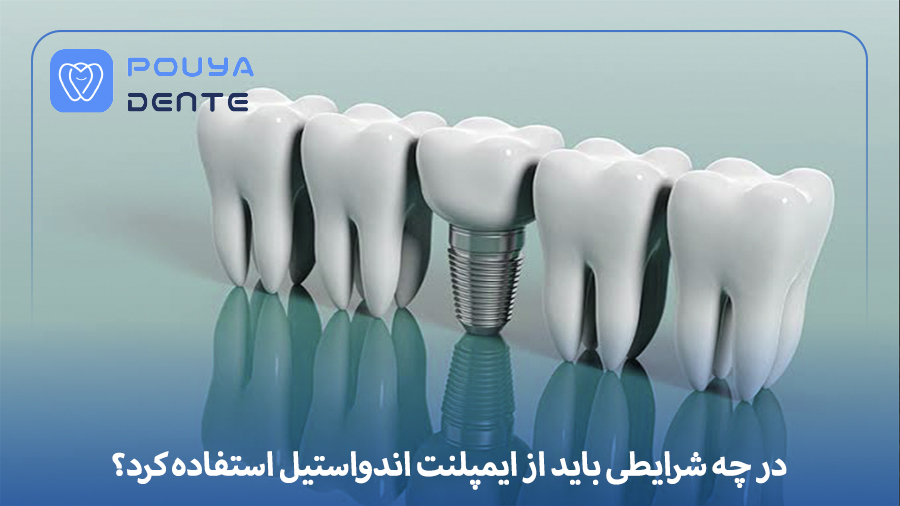 Endostyle implant