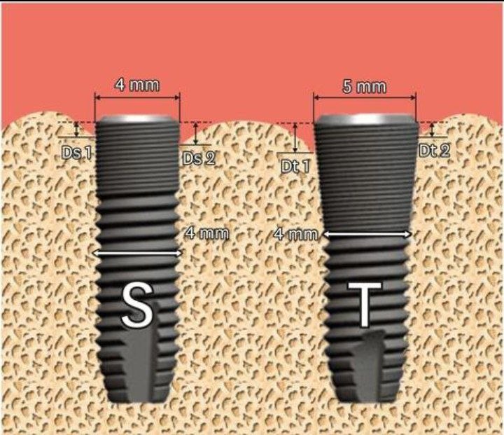 Initial implant stability