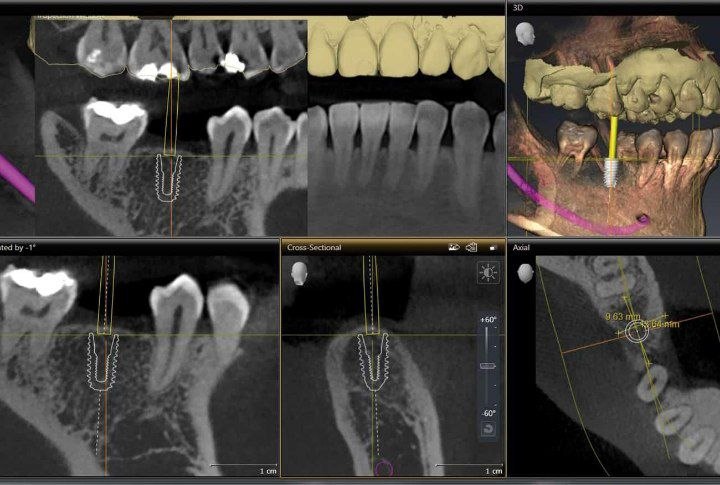 Initial implant stability