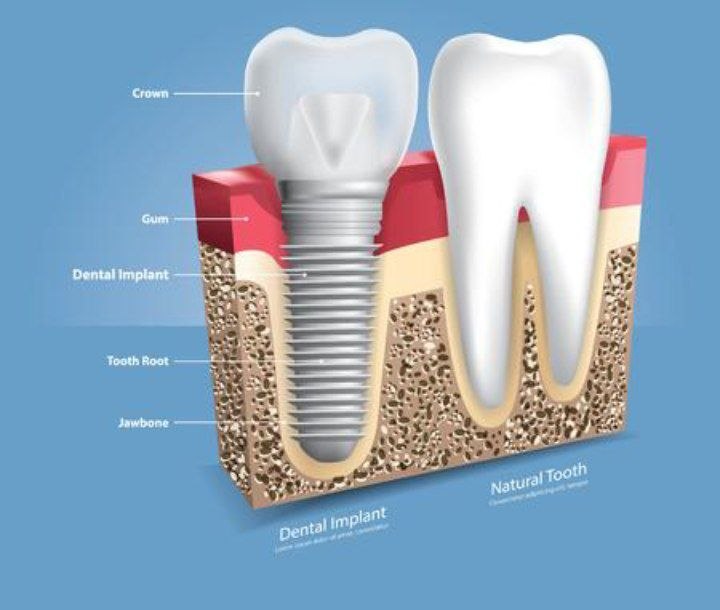 Implants or tooth preservation