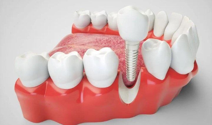 Implants or tooth preservation