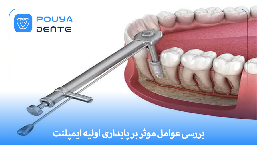 initial-implant-stability
