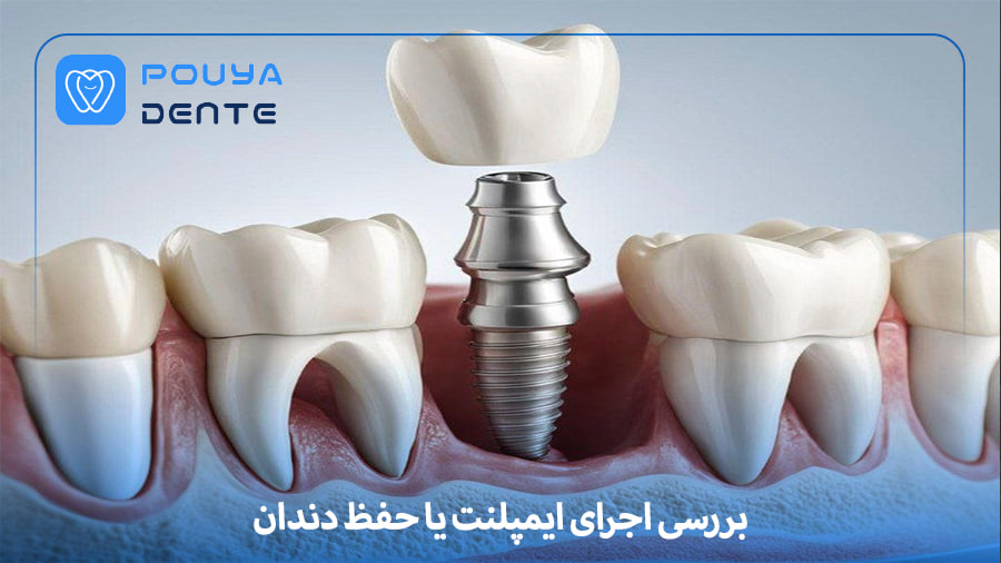 implants-or-tooth-preservation