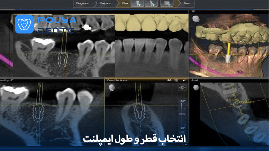 choosing-the-diameter-and-length-of-the-implant