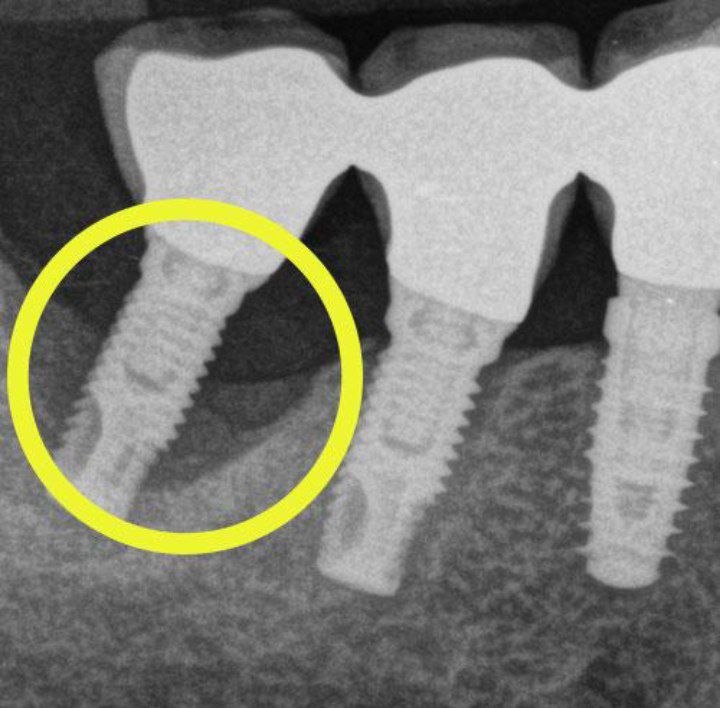 Early implant failure