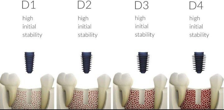 Early implant failure