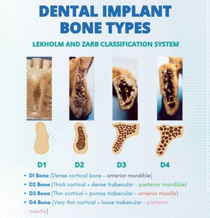 Early implant failure
