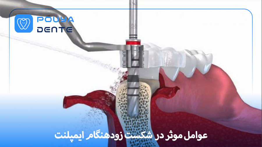 Early implant failure