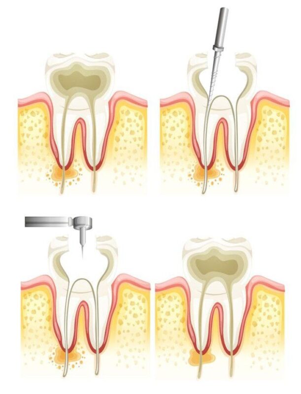 Root canal treatment failure