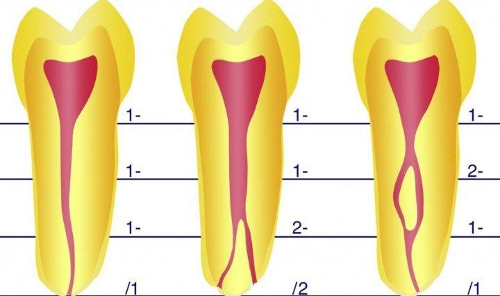 Root canal treatment failure