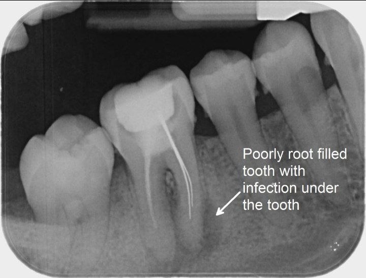 Root canal treatment failure