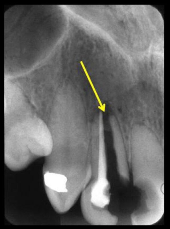 Root canal treatment failure
