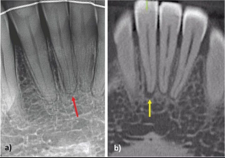Root canal treatment failure