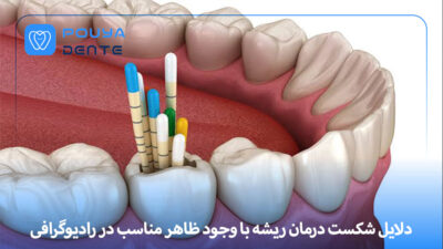Root canal treatment failure