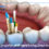 Root canal treatment failure
