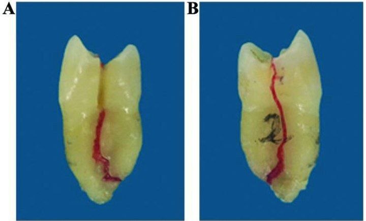 Vertical root crack