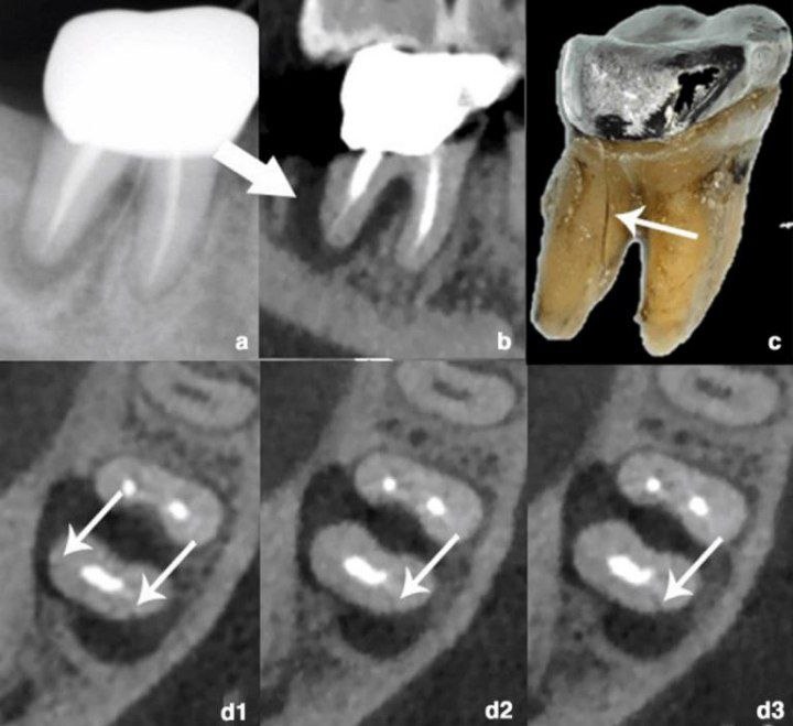 Vertical root crack