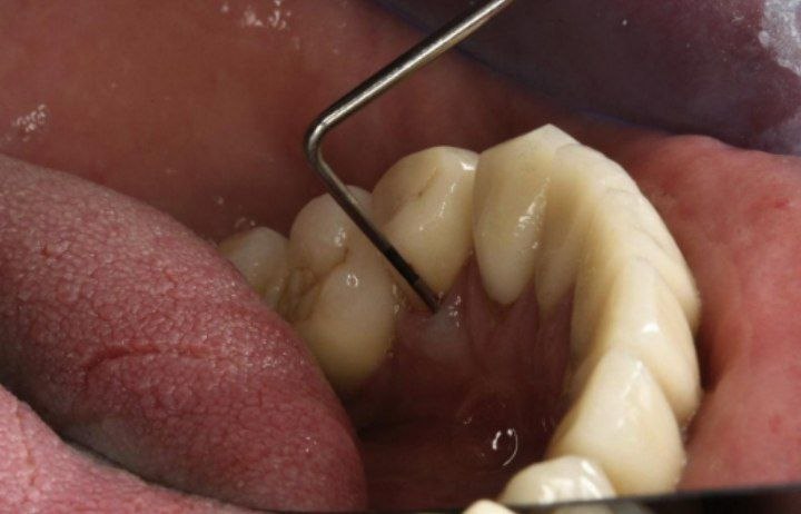 Vertical root crack