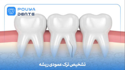 ترک عمودی ریشه