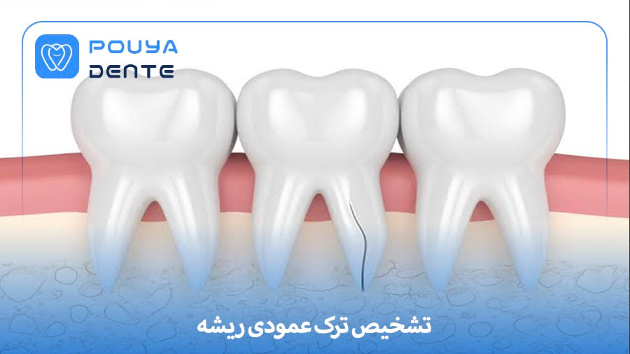 ترک عمودی ریشه