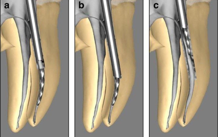 Rotary file stuck inside the tooth canal