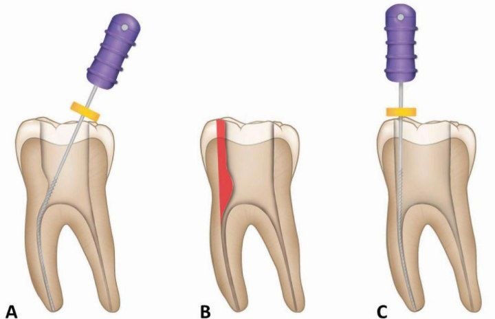 Rotary file stuck inside the tooth canal