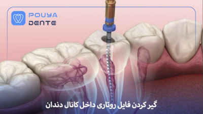 Rotary file stuck inside the tooth canal