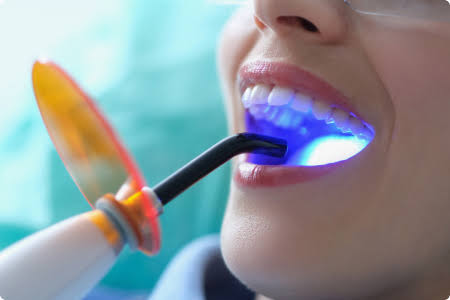 Decline in light-curing performance