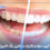 Discoloration of dental composite