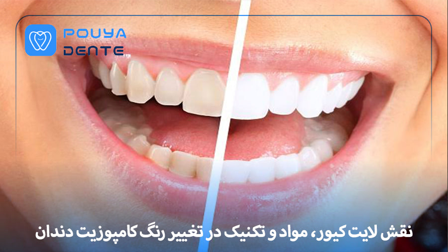 Discoloration of dental composite