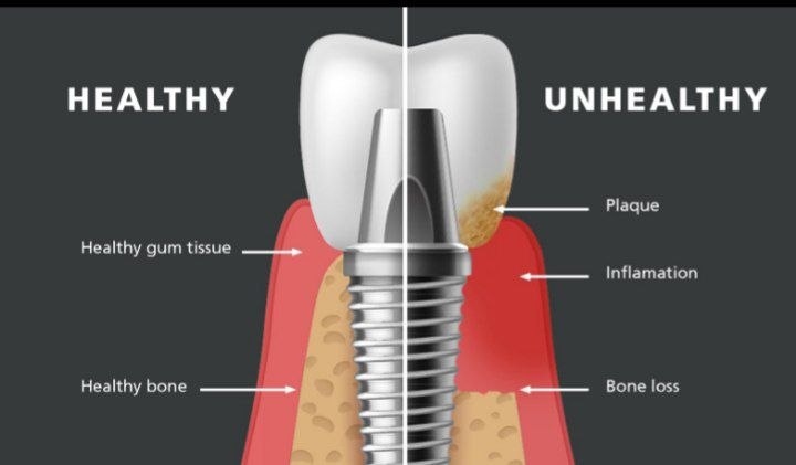 Peri-implantitis