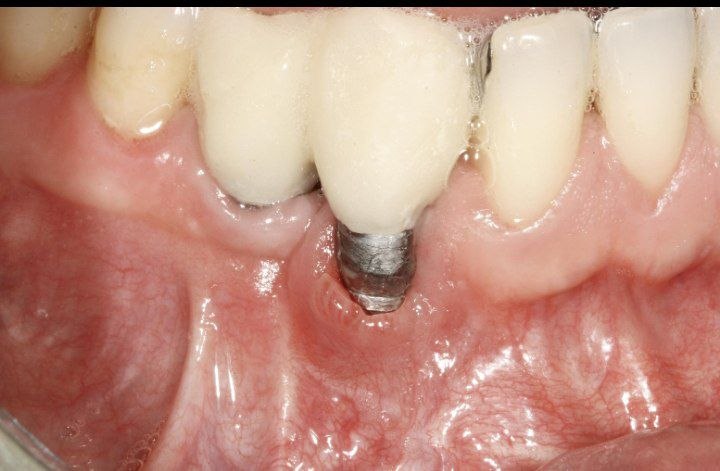 Peri-implantitis