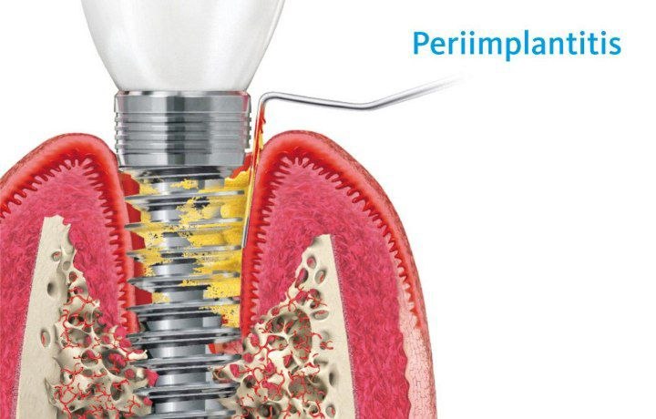 Peri-implantitis
