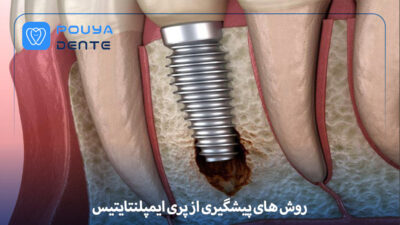 Peri-implantitis