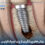 Peri-implantitis