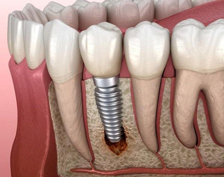 osseointegration failure