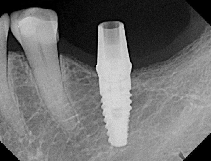 osseointegration failure