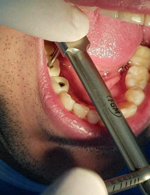 implant-torque-wrench