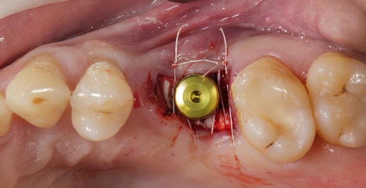 implant-sutures