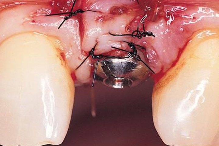 implant-sutures