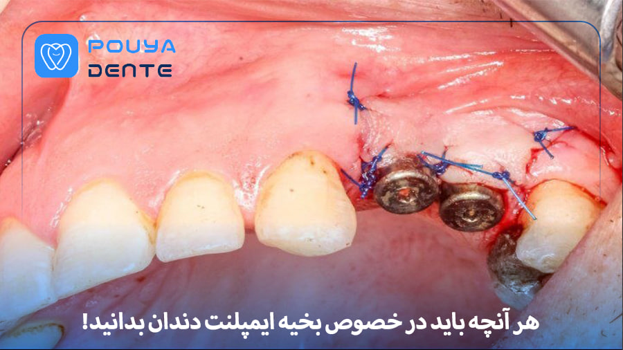 Implant sutures