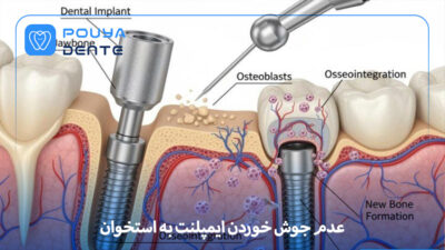 osseointegration failure