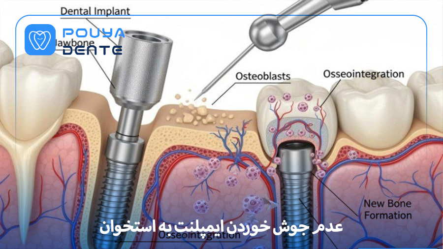 osseointegration failure