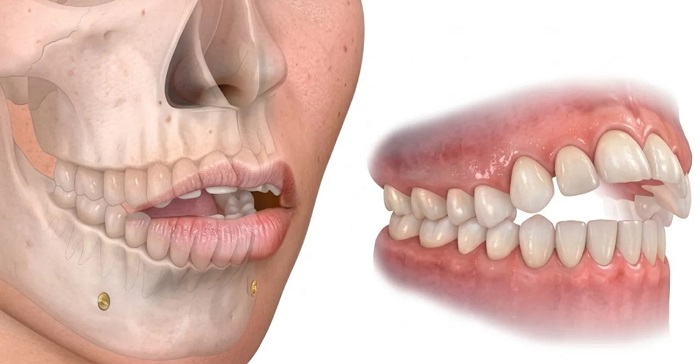 dental-malocclusion